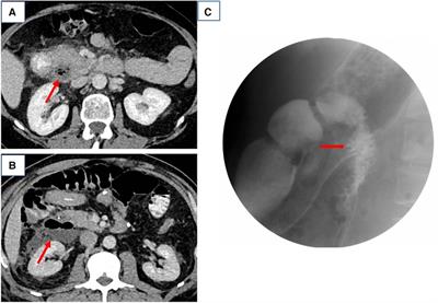 Spontaneous perforation of a primary duodenal diverticulum stepped treatment model: A 10-patient case report
